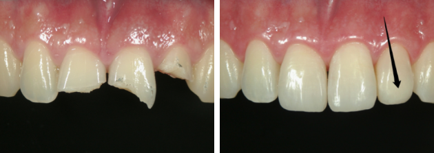 ダイレクト コンポジット レジン(DCR)による前歯治療