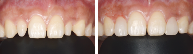 歯周病による歯と歯の隙間の治療