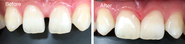 ダイレクト コンポジット レジン(DCR)による前歯治療