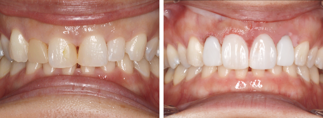 �_�C���N�g�{���f�B���O