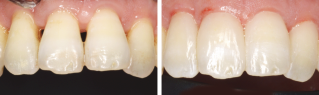 歯周病による歯と歯の隙間の治療