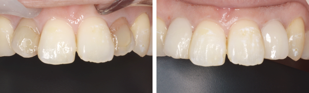 �_�C���N�g�{���f�B���O�@���É�