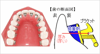 従来の舌側矯正装置