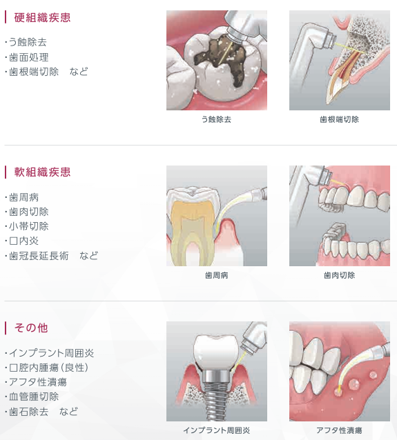 虫歯治療 レーザー 名古屋