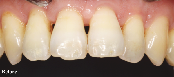 歯周病治療後の歯と歯の間の隙間