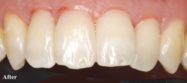 歯と歯茎のアンチエイジング