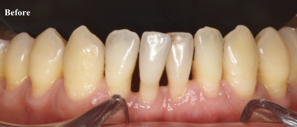 歯周病治療後の歯と歯の間の隙間