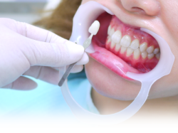 審美歯科治療の流れ
